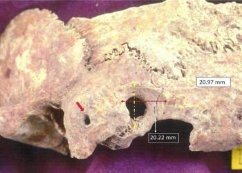 The remnants of a skull on which a complex form of brain surgery was performed. Image Credit: University of Adelphi.