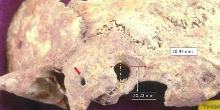 The remnants of a skull on which a complex form of brain surgery was performed. Image Credit: University of Adelphi.