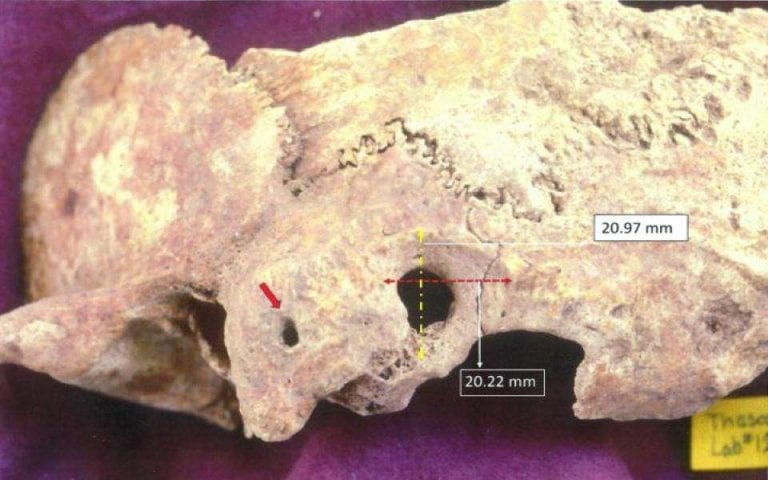 The remnants of a skull on which a complex form of brain surgery was performed. Image Credit: University of Adelphi.