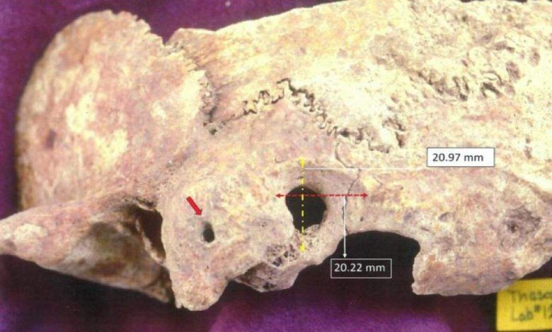 The remnants of a skull on which a complex form of brain surgery was performed. Image Credit: University of Adelphi.