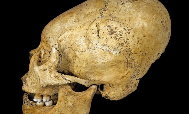 Deformed skull