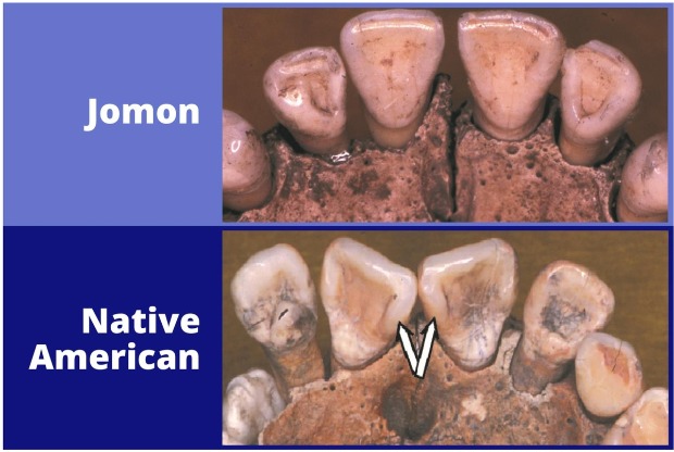 Comparison between Jomon and Native American teeth. Credit: G. Richard Scott