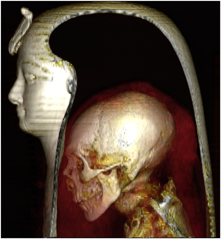 3D CT image of the head of the mummy. Credit: Sahar Saleem and Zahi Hawass / Frontiers in Medicine, 2021