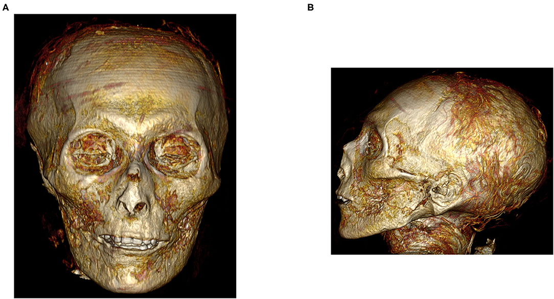 3D view of the digitally unwrapped mummy of Amenhotep I. Credit: Sahar Saleem and Zahi Hawass / Frontiers in Medicine, 2021