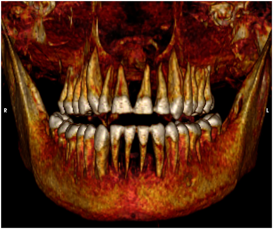 This image shows the healthy teeth of Amenhotep I. Credit: Sahar Saleem and Zahi Hawass / Frontiers in Medicine, 2021