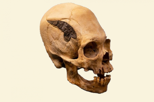 The Peruvian elongated skull with a metal implant - original image. Credit: Museum of Osteology