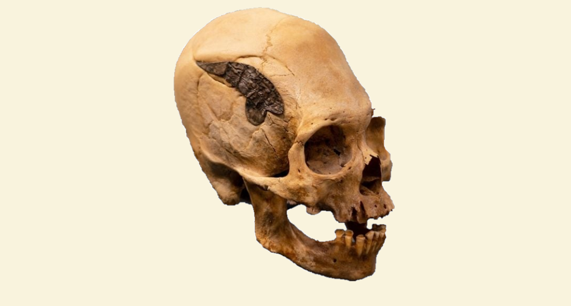 The Peruvian elongated skull with a metal implant - original image. Credit: Museum of Osteology