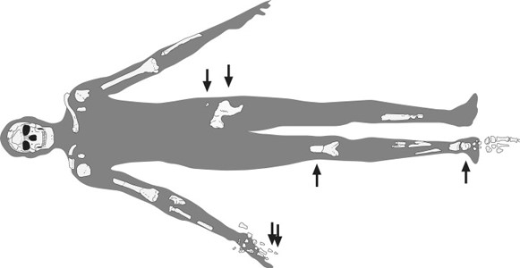 Found parts of the skeleton of Omo I. Arrows indicate bones obtained during excavations in 1999–2003. Credit: Journal of Human Evolution . 2008. V. 55. P. 421–437