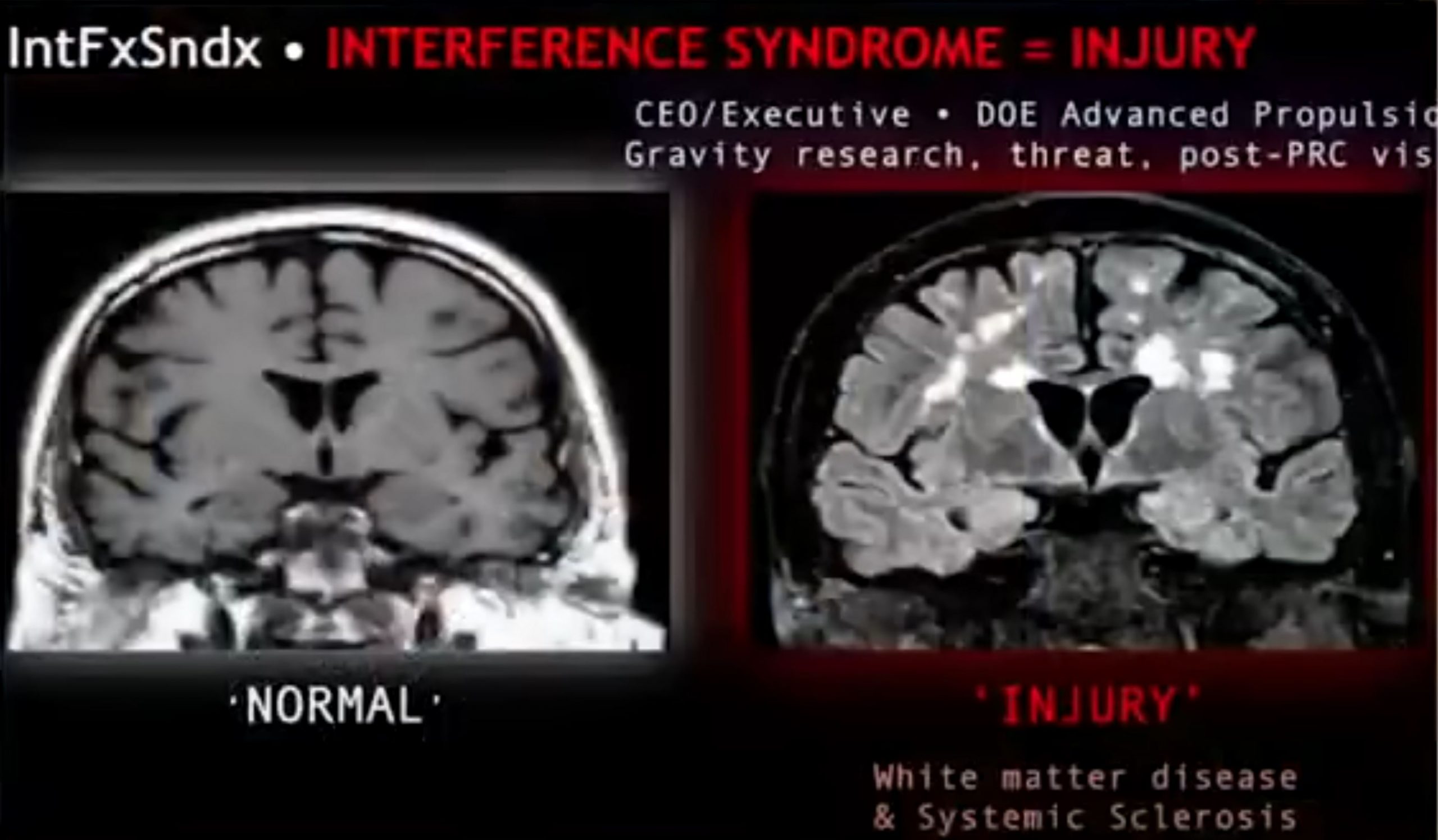 A screenshot from the interview showing an MRI scan from an individual who get too close to a UFO. Image Credit: YouTube.